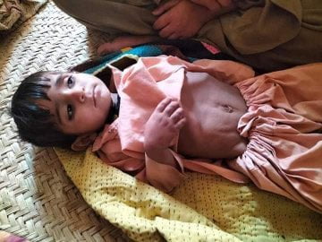 7/10 mothers die in Balochistan during child birth, while children are suffering from Malnutrition disorders